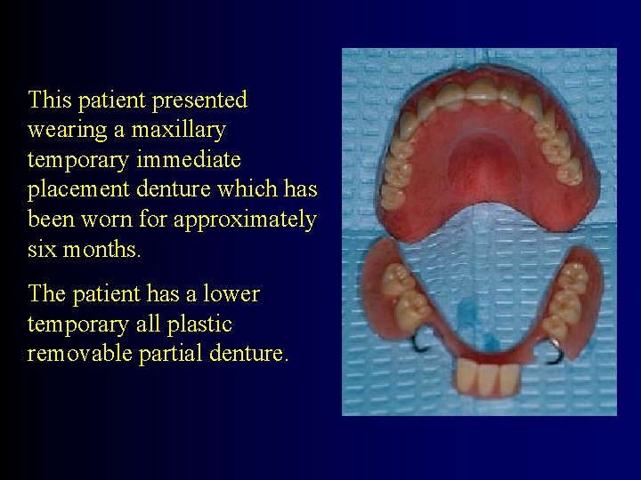 This patient presented wearing a maxillary temporary immediate placement denture which has been worn