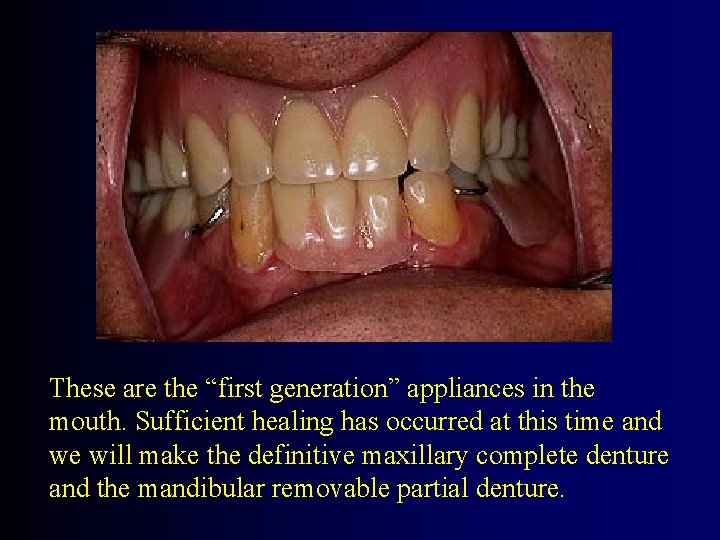 These are the “first generation” appliances in the mouth. Sufficient healing has occurred at