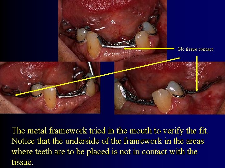 No tissue contact The metal framework tried in the mouth to verify the fit.