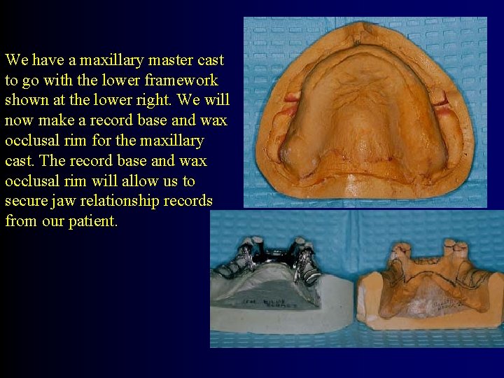 We have a maxillary master cast to go with the lower framework shown at