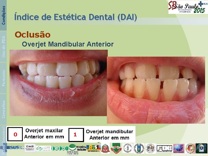 Oclusão Overjet Mandibular Anterior Condições Plano Amostral Conceitos Percurso Uso do PDA Índice de