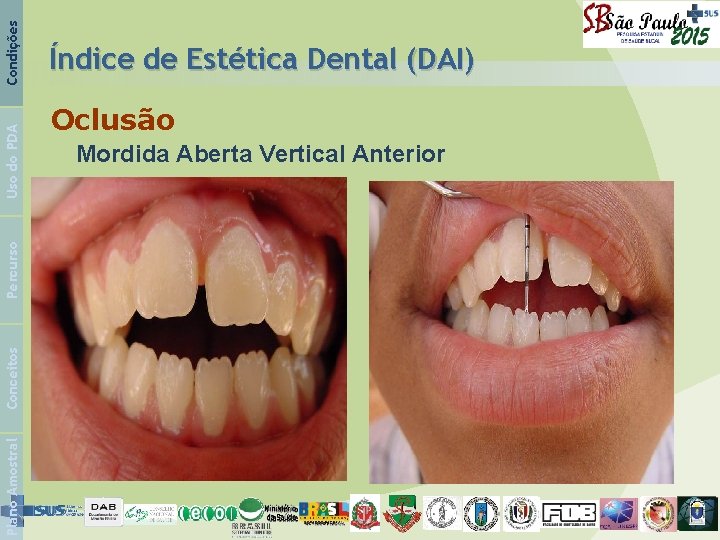 Condições Uso do PDA Percurso Conceitos Plano Amostral Índice de Estética Dental (DAI) Oclusão