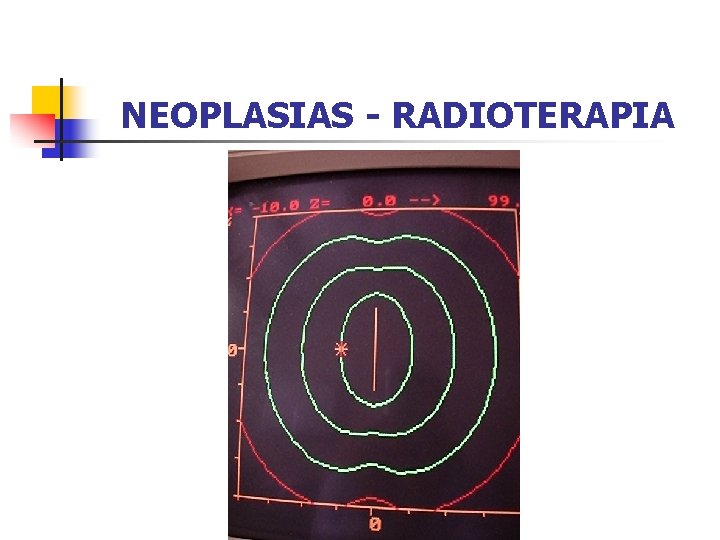 NEOPLASIAS - RADIOTERAPIA BRAQUITERAPIA 