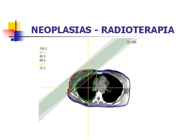 NEOPLASIAS - RADIOTERAPIA 