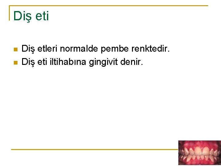 Diş eti n n Diş etleri normalde pembe renktedir. Diş eti iltihabına gingivit denir.