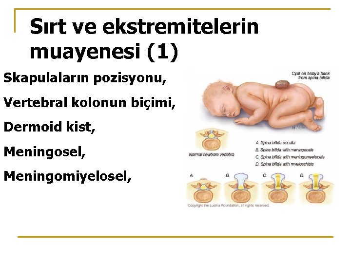 Sırt ve ekstremitelerin muayenesi (1) Skapulaların pozisyonu, Vertebral kolonun biçimi, Dermoid kist, Meningosel, Meningomiyelosel,