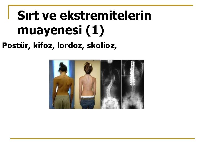 Sırt ve ekstremitelerin muayenesi (1) Postür, kifoz, lordoz, skolioz, 