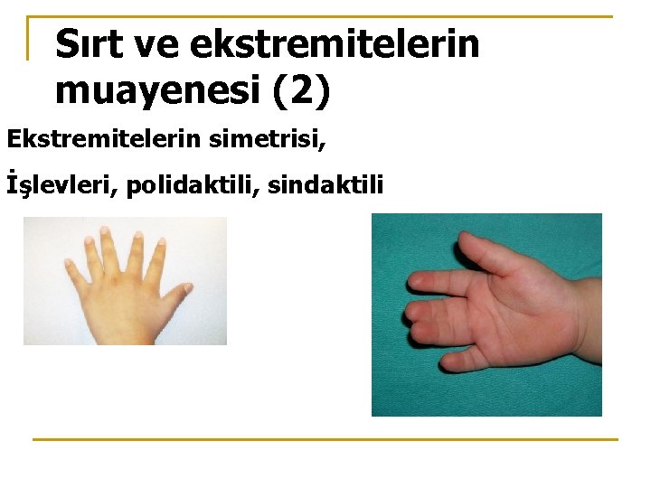 Sırt ve ekstremitelerin muayenesi (2) Ekstremitelerin simetrisi, İşlevleri, polidaktili, sindaktili 