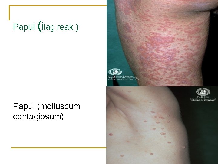 Papül (İlaç reak. ) Papül (molluscum contagiosum) 