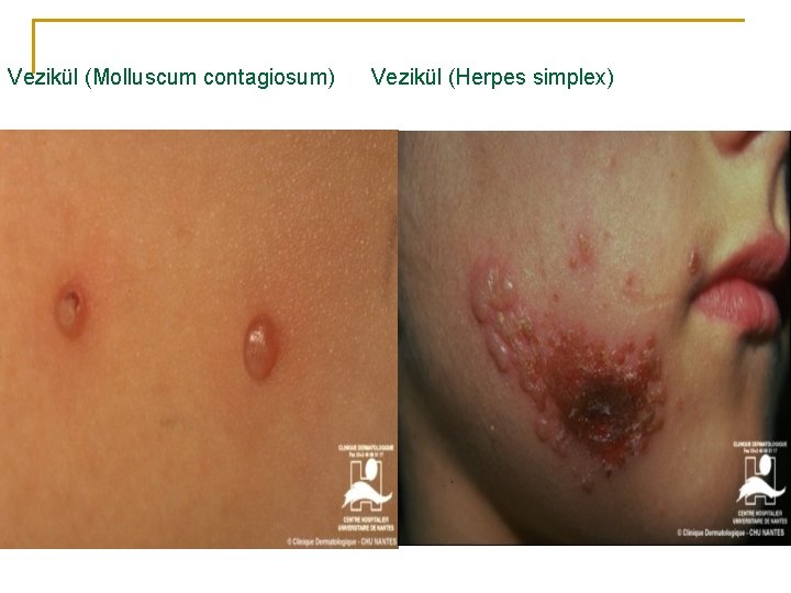 Vezikül (Molluscum contagiosum) Vezikül (Herpes simplex) 