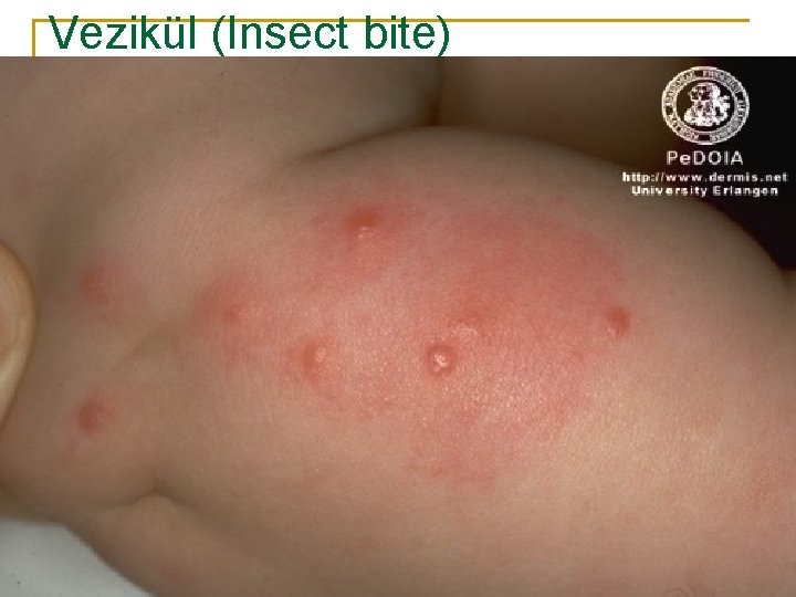 Vezikül (Insect bite) 