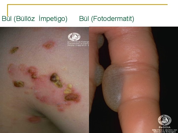 Bül (Büllöz İmpetigo) Bül (Fotodermatit) 