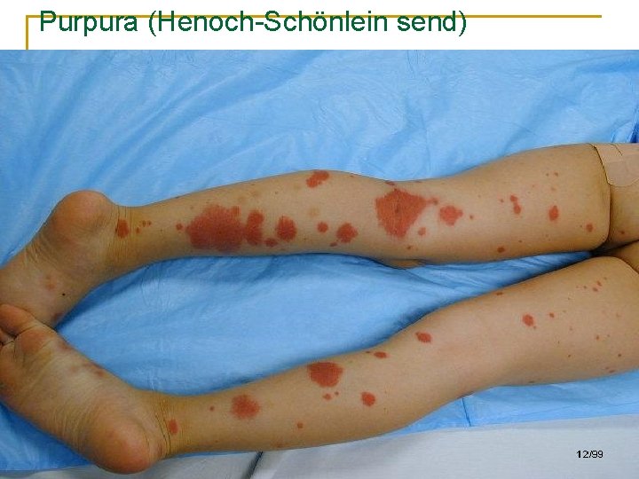 Purpura (Henoch-Schönlein send) 