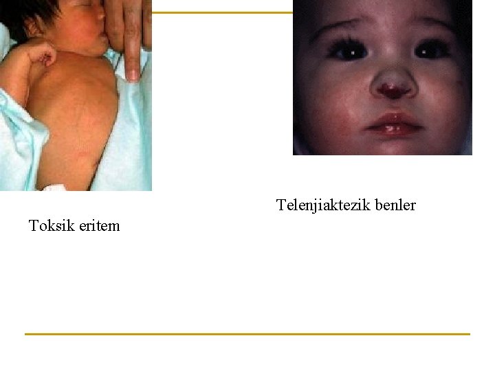 Telenjiaktezik benler Toksik eritem 