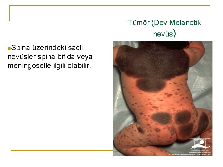 Tümör (Dev Melanotik nevüs) n. Spina üzerindeki saçlı nevüsler spina bifida veya meningoselle ilgili