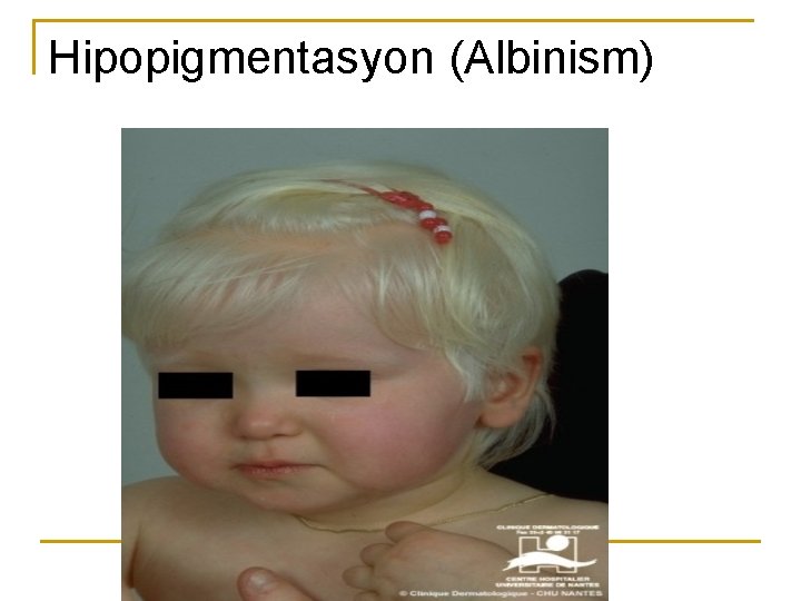 Hipopigmentasyon (Albinism) 