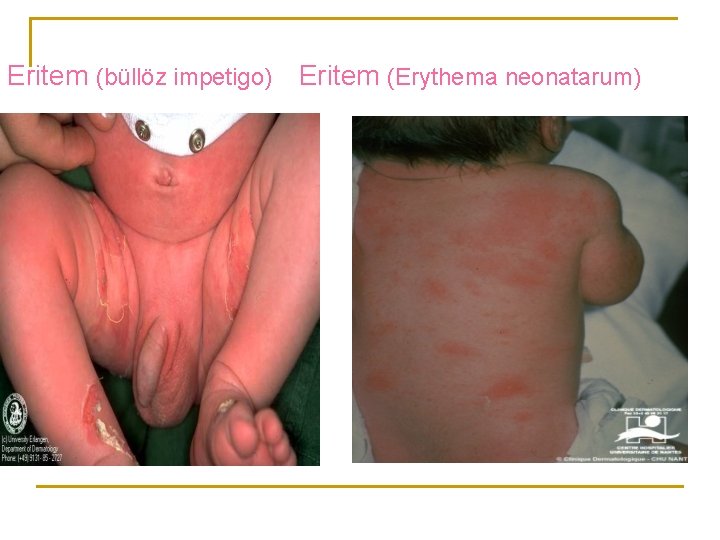 Eritem (büllöz impetigo) Eritem (Erythema neonatarum) 