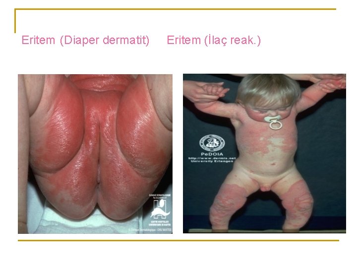 Eritem (Diaper dermatit) Eritem (İlaç reak. ) 