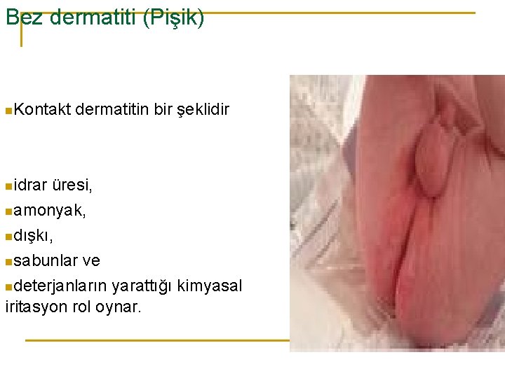 Bez dermatiti (Pişik) n. Kontakt dermatitin bir şeklidir nidrar üresi, namonyak, ndışkı, nsabunlar ve