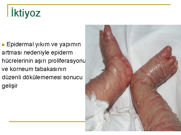 İktiyoz Epidermal yıkım ve yapımın artması nedeniyle epiderm hücrelerinin aşırı proliferasyonu ve korneum tabakasının