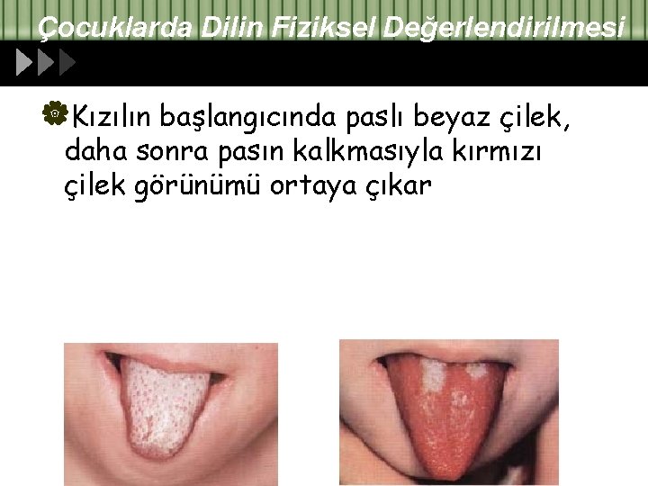 Çocuklarda Dilin Fiziksel Değerlendirilmesi |Kızılın başlangıcında paslı beyaz çilek, daha sonra pasın kalkmasıyla kırmızı