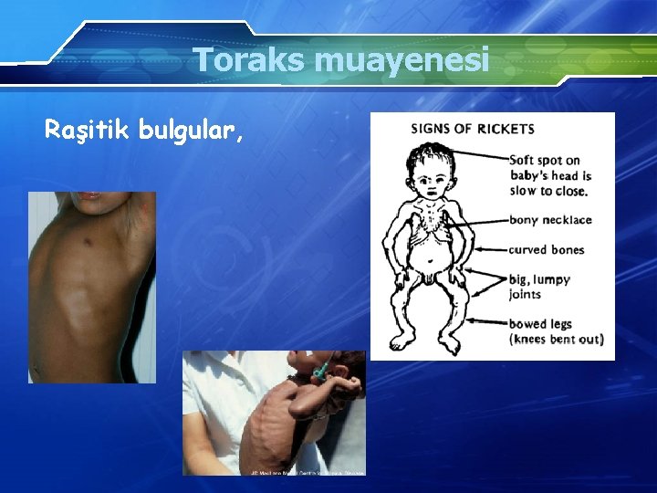 Toraks muayenesi Raşitik bulgular, 