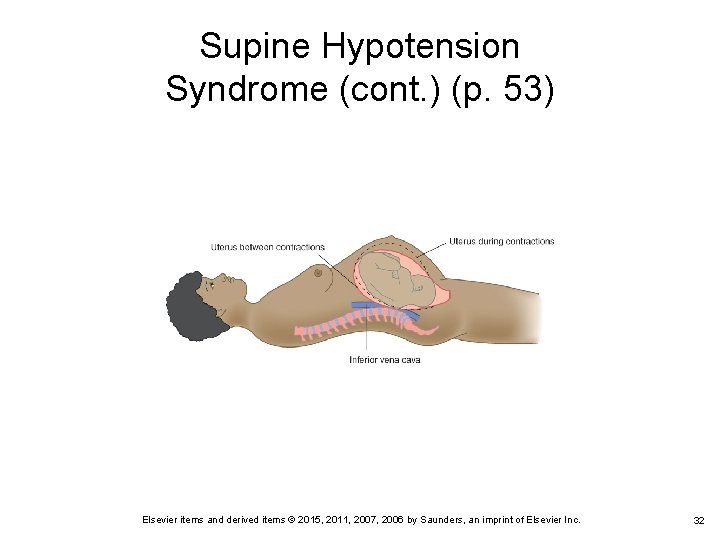 Supine Hypotension Syndrome (cont. ) (p. 53) Elsevier items and derived items © 2015,