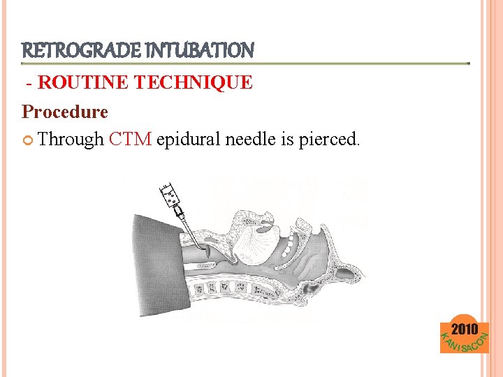 RETROGRADE INTUBATION - ROUTINE TECHNIQUE Procedure Through CTM epidural needle is pierced. 