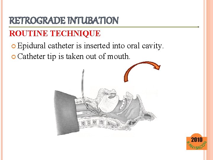 RETROGRADE INTUBATION ROUTINE TECHNIQUE Epidural catheter is inserted into oral cavity. Catheter tip is