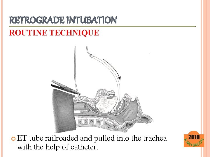 RETROGRADE INTUBATION ROUTINE TECHNIQUE ET tube railroaded and pulled into the trachea with the