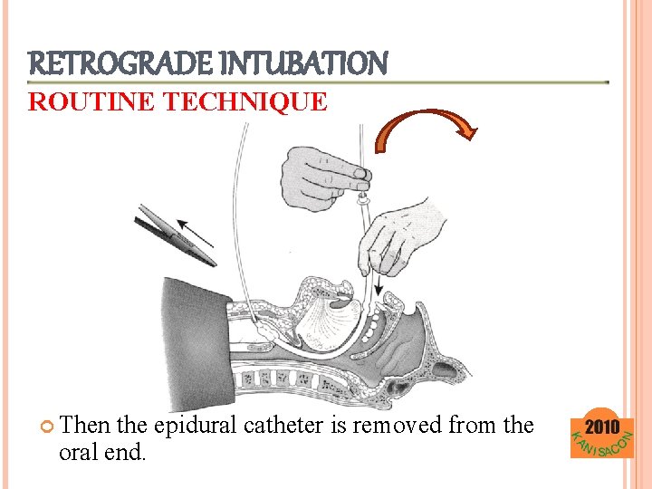 RETROGRADE INTUBATION ROUTINE TECHNIQUE Then the epidural catheter is removed from the oral end.