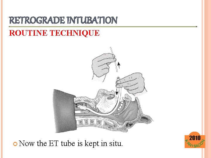 RETROGRADE INTUBATION ROUTINE TECHNIQUE Now the ET tube is kept in situ. 