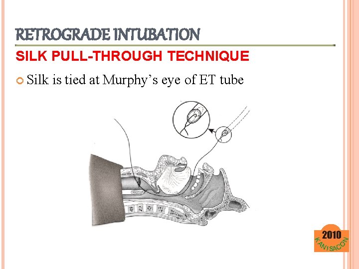 RETROGRADE INTUBATION SILK PULL-THROUGH TECHNIQUE Silk is tied at Murphy’s eye of ET tube