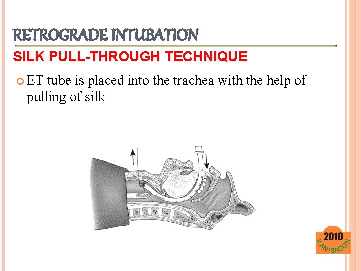 RETROGRADE INTUBATION SILK PULL-THROUGH TECHNIQUE ET tube is placed into the trachea with the