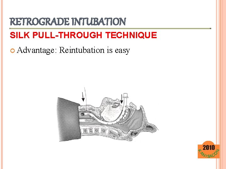 RETROGRADE INTUBATION SILK PULL-THROUGH TECHNIQUE Advantage: Reintubation is easy 