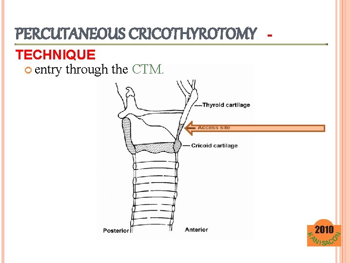 PERCUTANEOUS CRICOTHYROTOMY TECHNIQUE entry through the CTM. - 