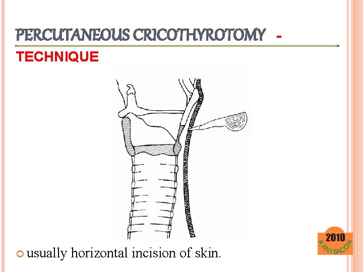PERCUTANEOUS CRICOTHYROTOMY TECHNIQUE usually horizontal incision of skin. - 