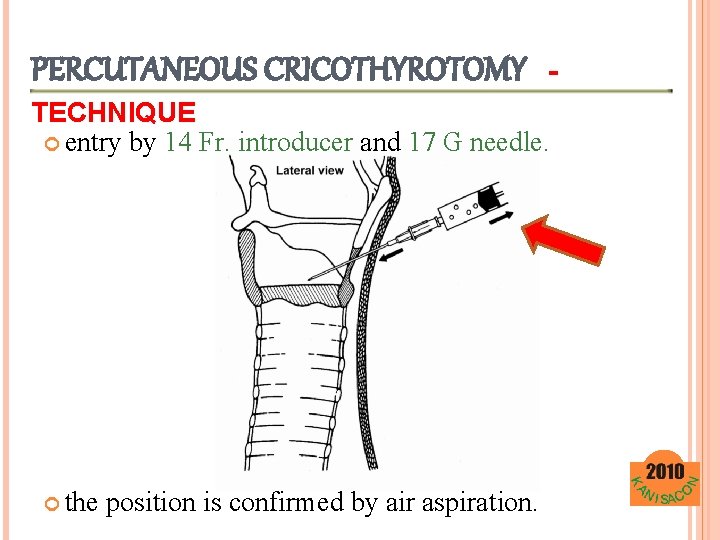 PERCUTANEOUS CRICOTHYROTOMY - TECHNIQUE entry by 14 Fr. introducer and 17 G needle. the