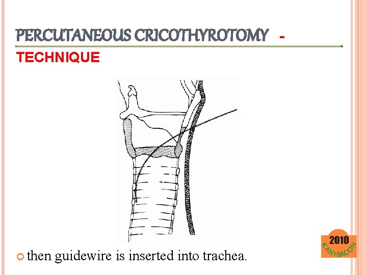 PERCUTANEOUS CRICOTHYROTOMY TECHNIQUE then guidewire is inserted into trachea. - 