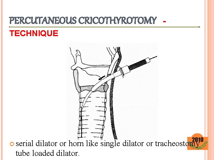 PERCUTANEOUS CRICOTHYROTOMY - TECHNIQUE serial dilator or horn like single dilator or tracheostomy tube