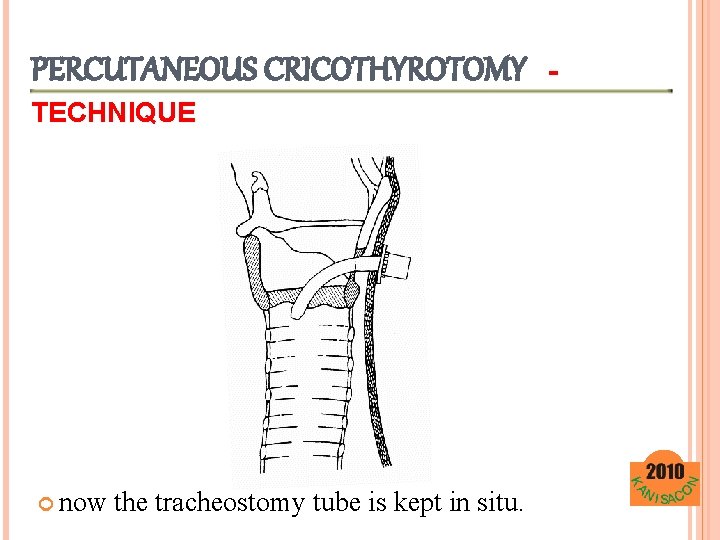 PERCUTANEOUS CRICOTHYROTOMY TECHNIQUE now the tracheostomy tube is kept in situ. - 