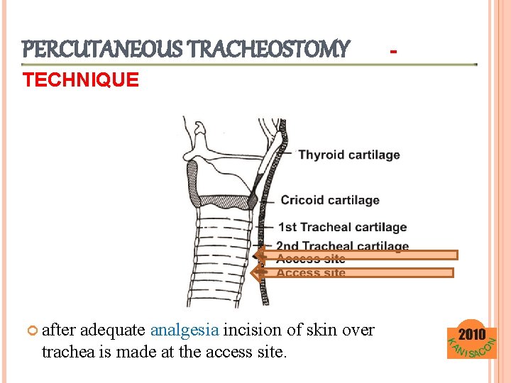 PERCUTANEOUS TRACHEOSTOMY TECHNIQUE after adequate analgesia incision of skin over trachea is made at