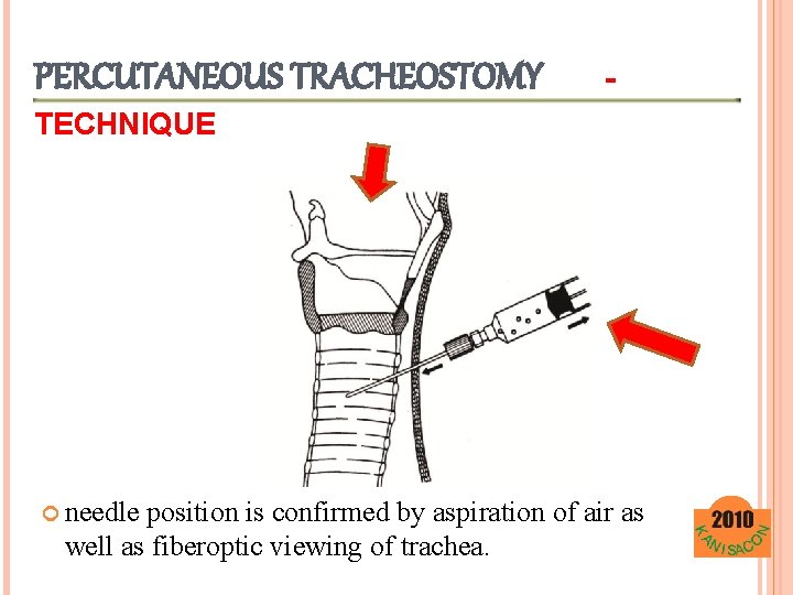 PERCUTANEOUS TRACHEOSTOMY - TECHNIQUE needle position is confirmed by aspiration of air as well