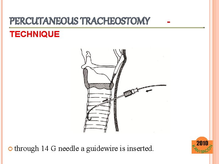 PERCUTANEOUS TRACHEOSTOMY TECHNIQUE through 14 G needle a guidewire is inserted. - 