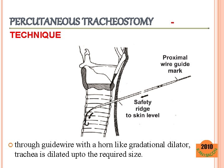 PERCUTANEOUS TRACHEOSTOMY - TECHNIQUE through guidewire with a horn like gradational dilator, trachea is