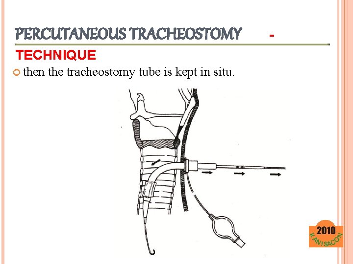 PERCUTANEOUS TRACHEOSTOMY TECHNIQUE then the tracheostomy tube is kept in situ. - 