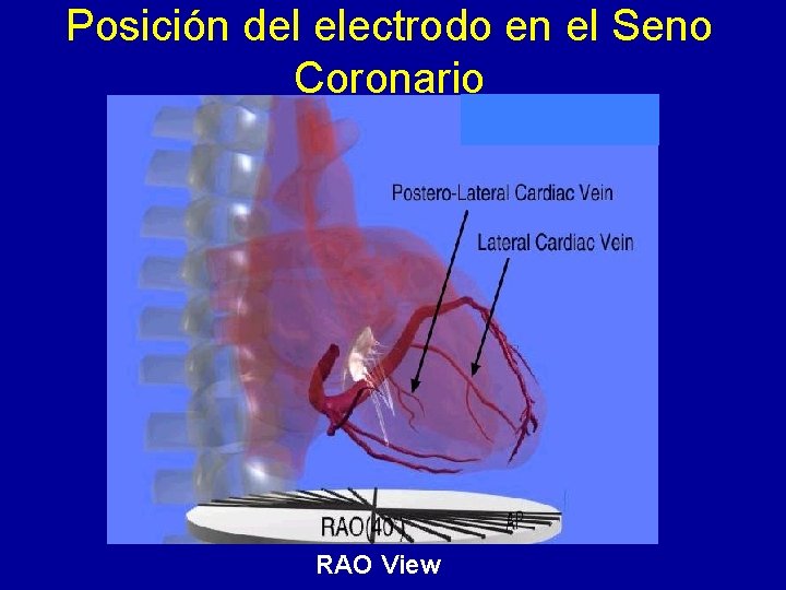 Posición del electrodo en el Seno Coronario RAO View 