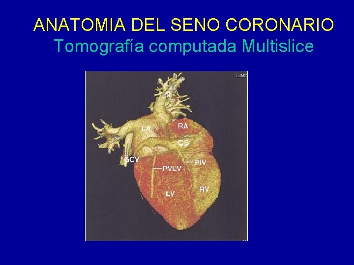 ANATOMIA DEL SENO CORONARIO Tomografía computada Multislice 