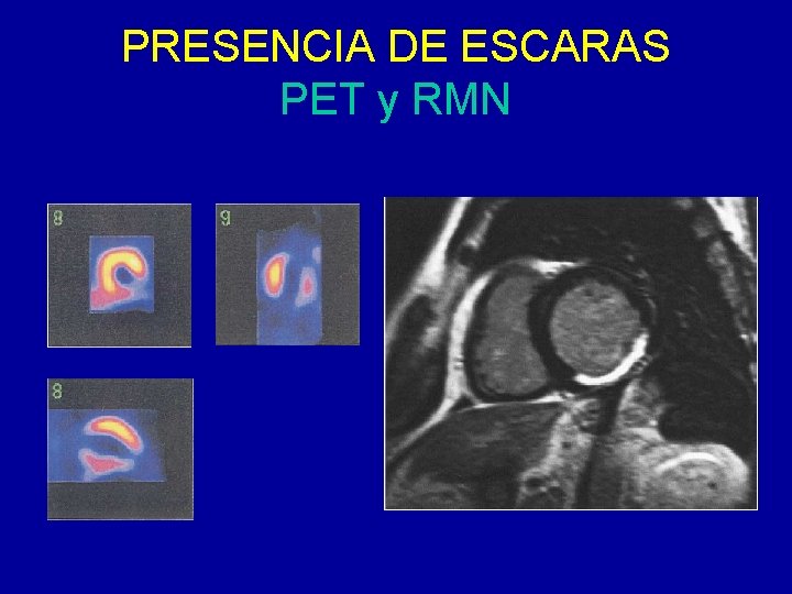 PRESENCIA DE ESCARAS PET y RMN 