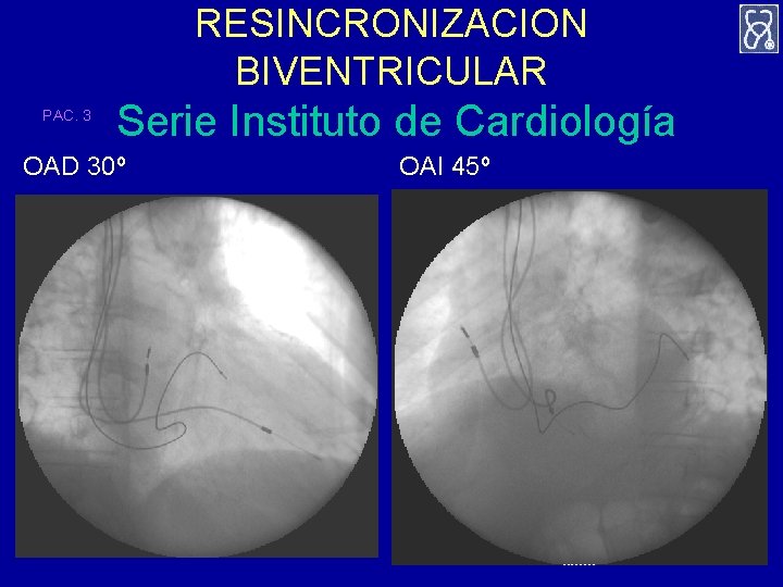 RESINCRONIZACION BIVENTRICULAR PAC. 3 Serie Instituto de Cardiología OAD 30º OAI 45º 